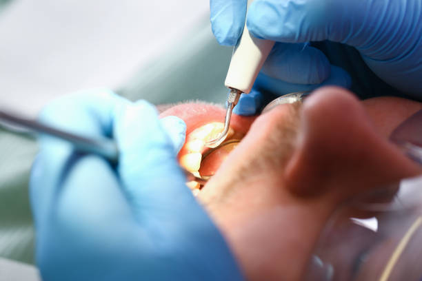 Best Emergency Wisdom Tooth Extraction in Holts Summit, MO